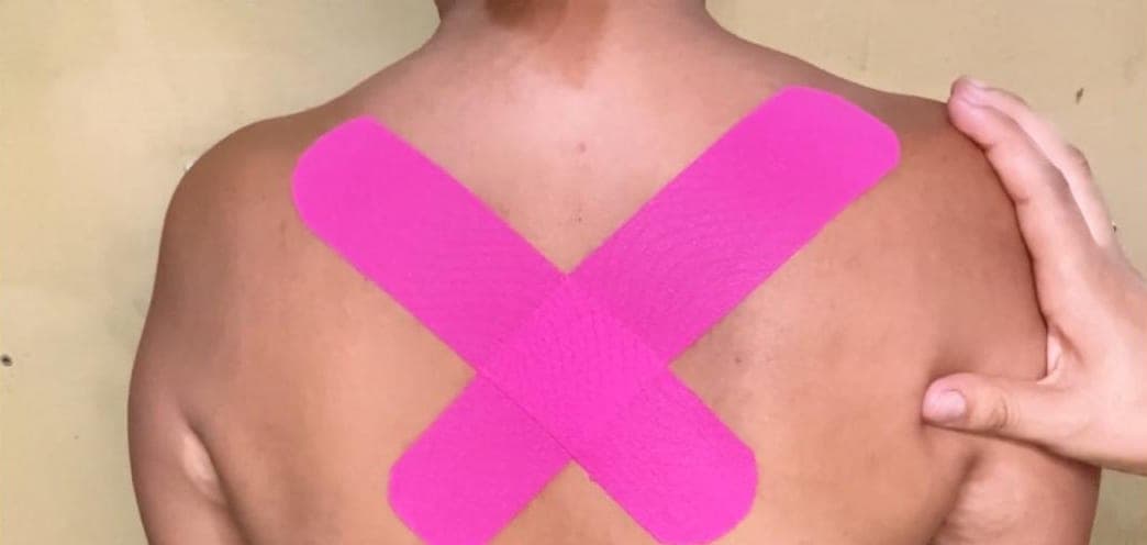 Costas de um paciente com duas fitas rosa de taping cruzadas em X entre os ombros.